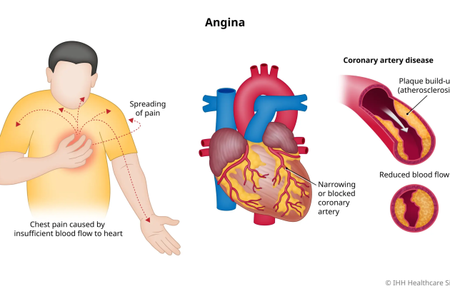 آنژین قلبی + آیا آنژین قلبی خطرناک است؟