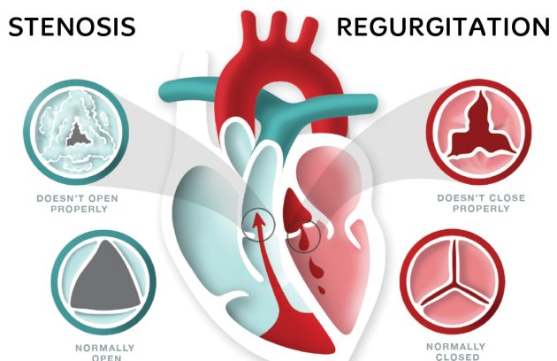 بیماری دریچه‌ای قلب چیست؟